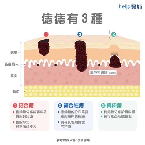 痣的形成原因|是痣？還是皮膚癌？皮膚科醫師教你揪出「假的痣」，。